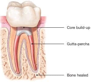 Root Canal: Procedure, What It Treats & Recovery