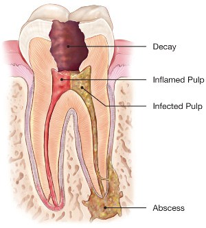 root canal infection