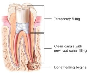 loose root canal crown