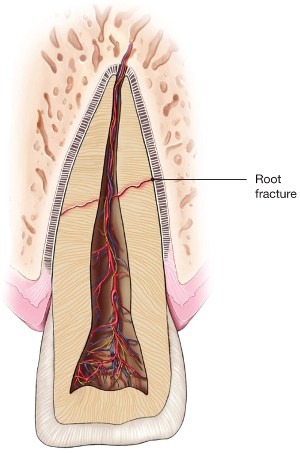 Root-Fracture | American Association of Endodontists