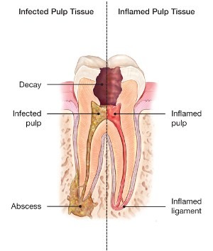 What Is A Root Canal American Association Of Endodontists