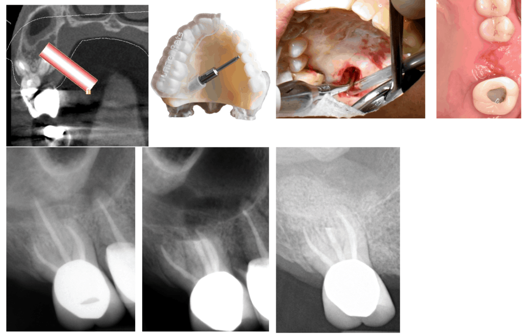 Targeted Endodontic Microsurgery - American Association Of Endodontists