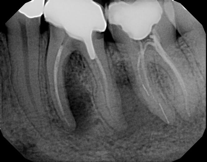 5 Questions to Ask When Determining if Teeth With Perio-Endo Infections ...